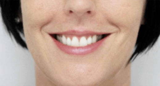 梅尔国际快讯 | 过度的使用注射剂后,你的笑容会被改变吗?