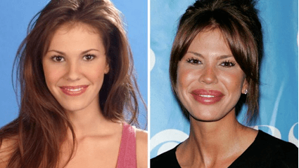 梅尔国际快讯 | 过度的使用注射剂后,你的笑容会被改变吗?