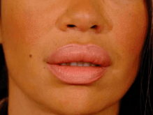 梅尔国际快讯 | 过度的使用注射剂后,你的笑容会被改变吗?