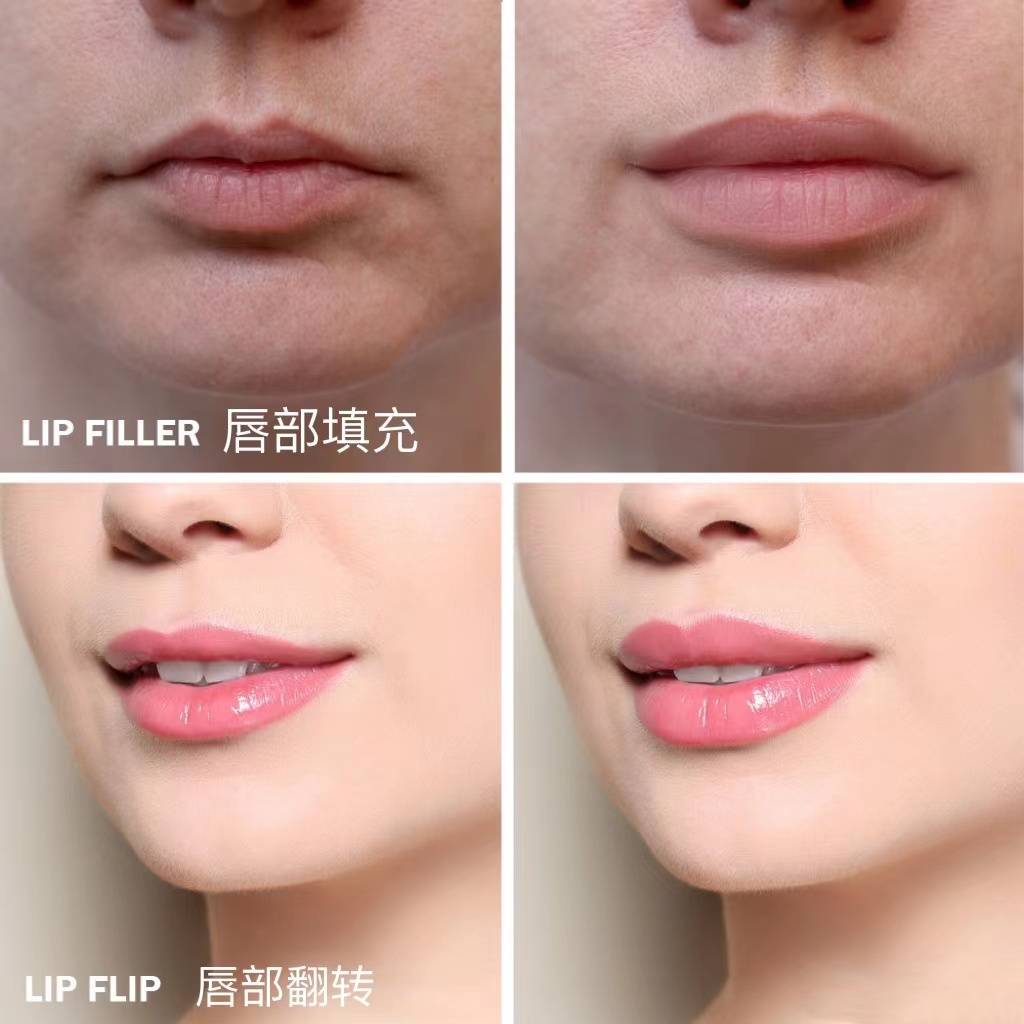 梅尔国际快讯 | 过度的使用注射剂后,你的笑容会被改变吗?