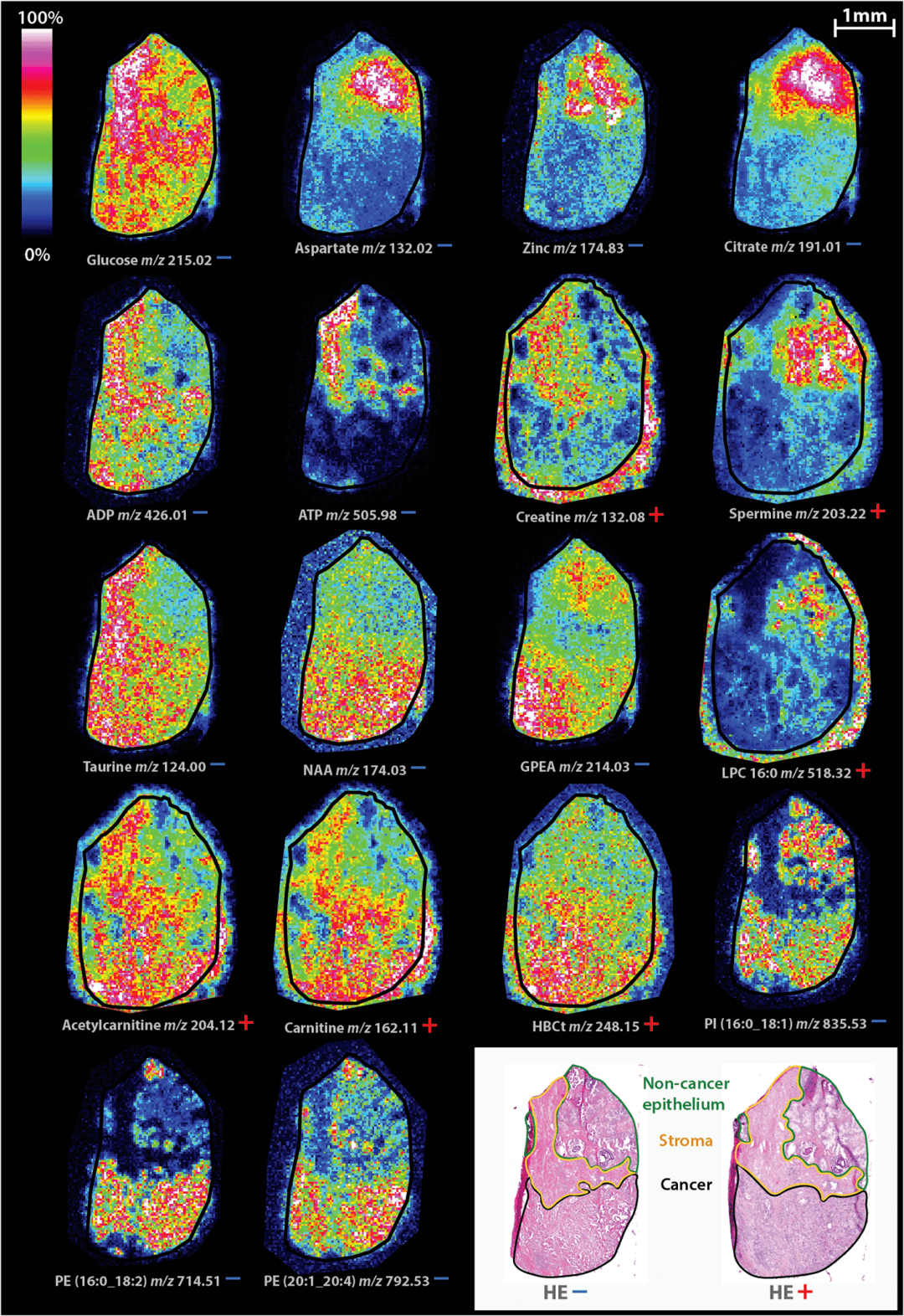 空间代谢组学技术研究前列腺癌的空间代谢差异