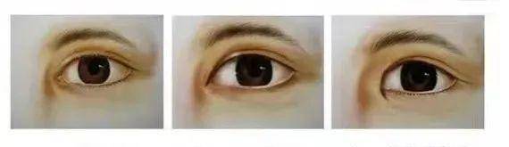 眼睛别再割双眼皮了!内双、肿眼泡的来啦!