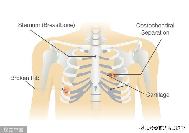 春遊戶外運動應注意防護如胸部肋骨損傷要用肋骨固定夾板嗎有什麼注意