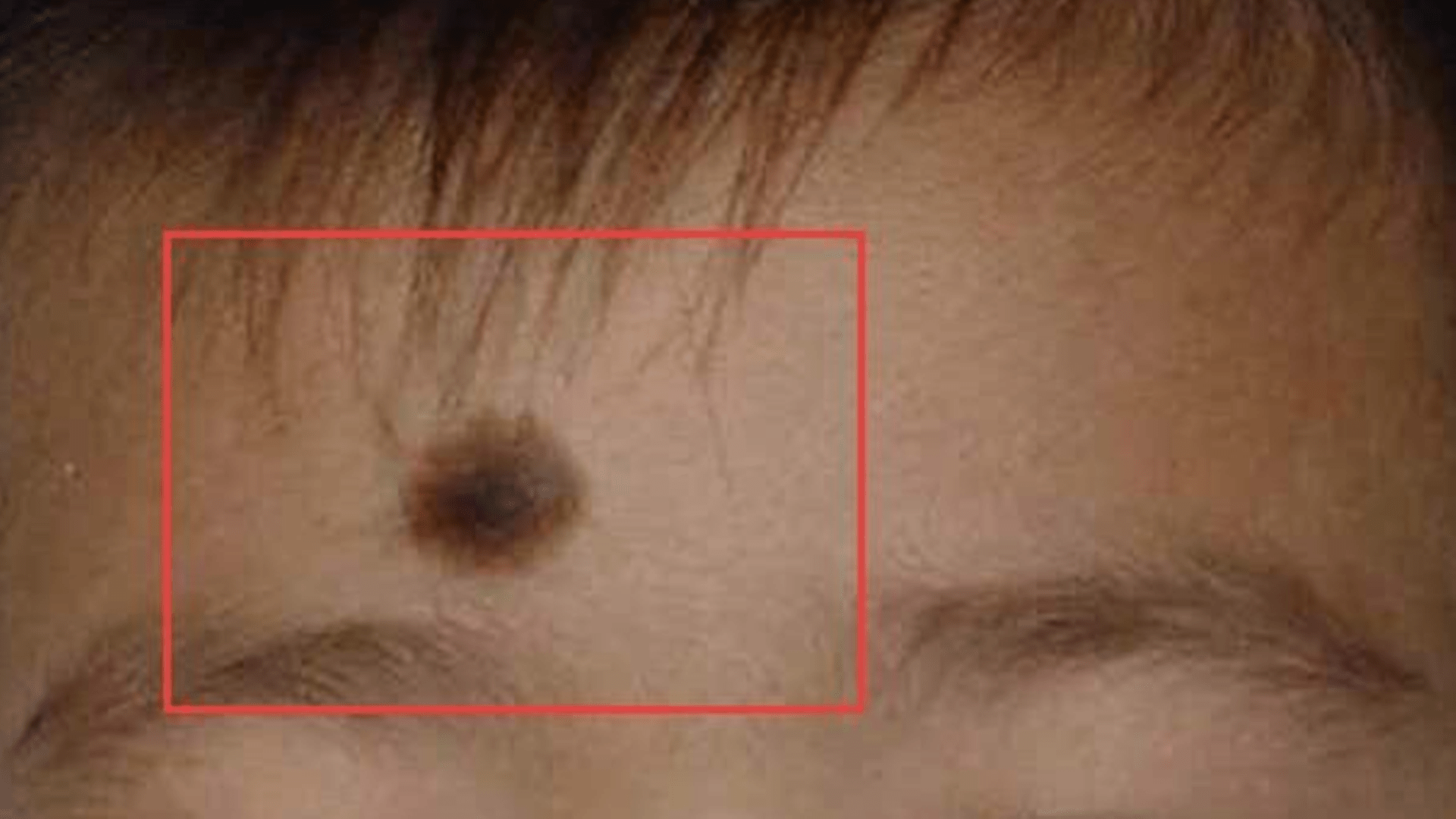 7张图片带你了解常见斑点（胎记）类型，请注意查收 - 知乎