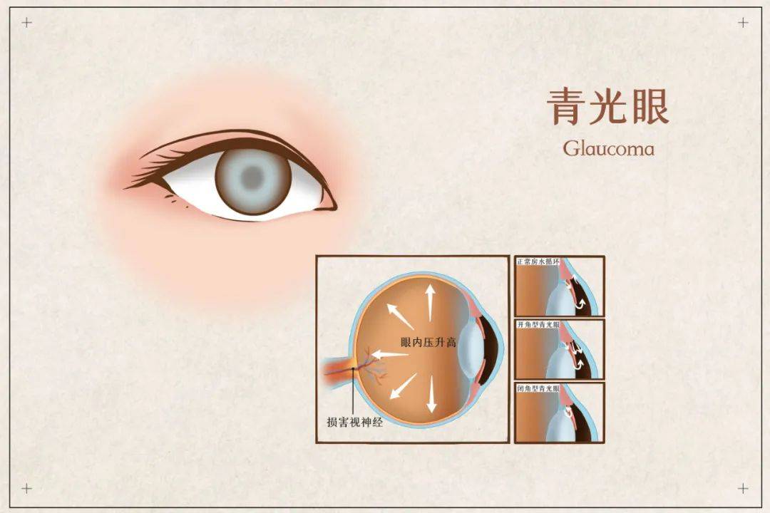 视力|【世界青光眼周】中国青光眼导管治疗技术国内领先