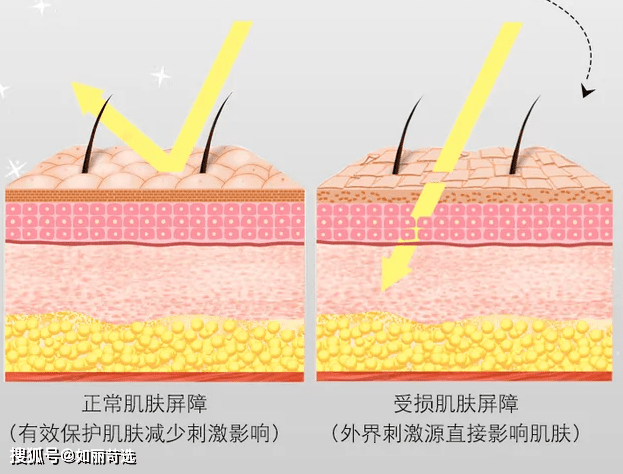 治疗痘痘只能靠医美手段改善吗？