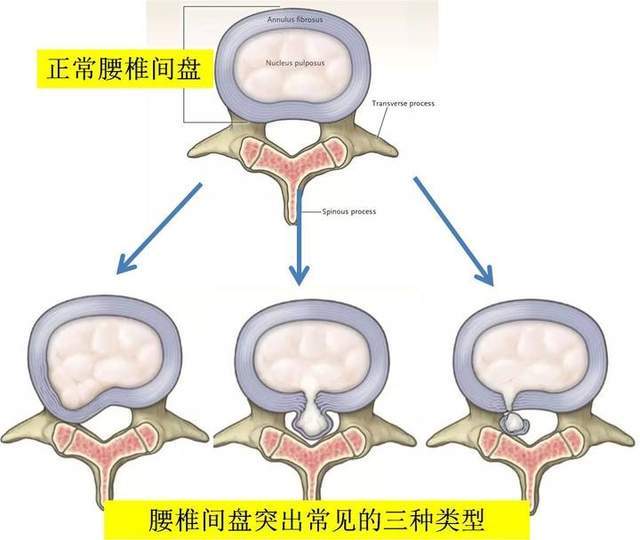 膨出和突出有区别吗图片