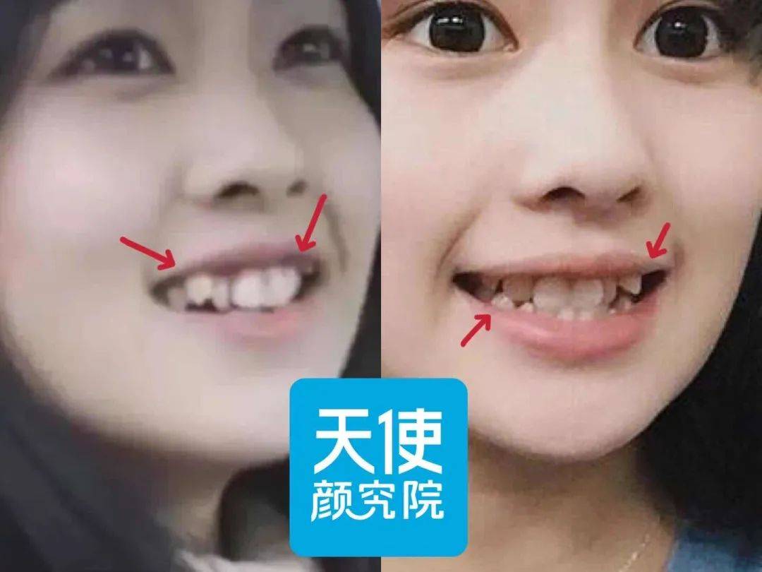 牙龈关晓彤是不是do脸了？凹脸变得幼态又平整！