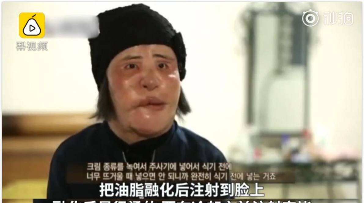 因为女星韩慧景：为了更漂亮，给脸注射食用油，把脸整成“猪头”