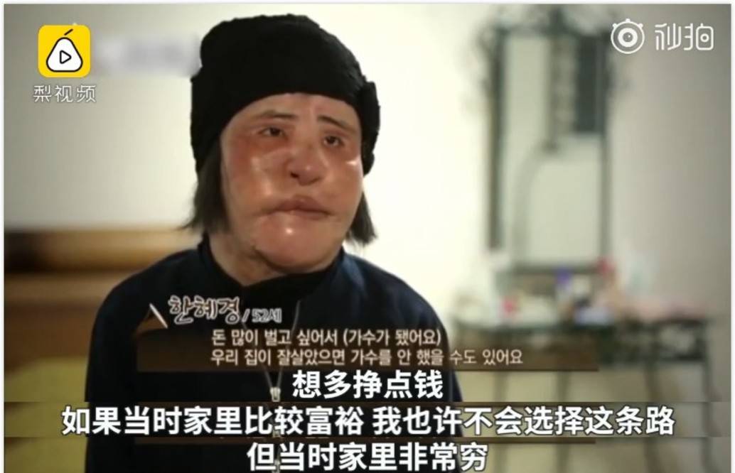 因为女星韩慧景：为了更漂亮，给脸注射食用油，把脸整成“猪头”