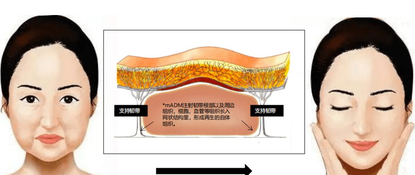 进行如何实现面部年轻化，爱缇恩mADM你焕回青春的福音
