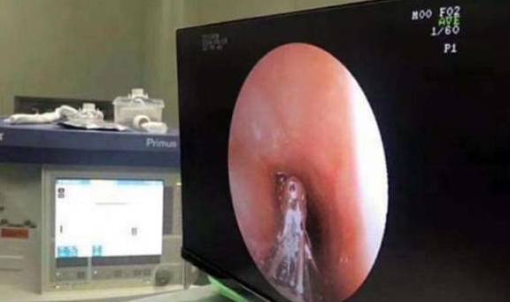 黑心|7岁男孩肚子疼,胃里发现一团“胶”,有些“营养零食”太坑娃