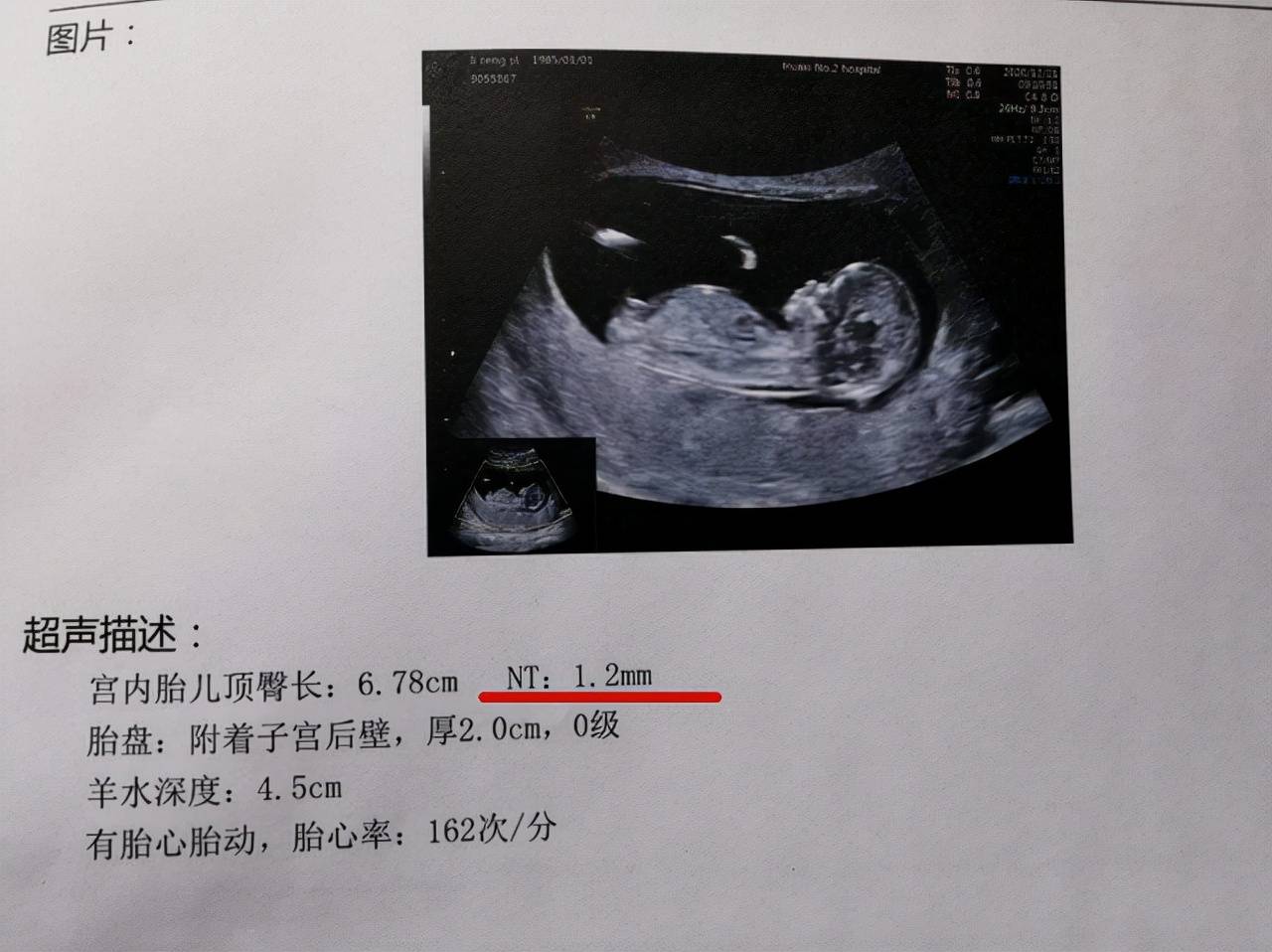 怀孕报告单图片高清图片
