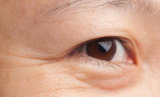 原创皮肤水分不足易导致眼角皱纹常做眼部运动告别眼角皱纹