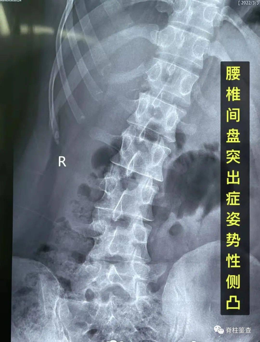 脊柱_神经_腰椎间盘