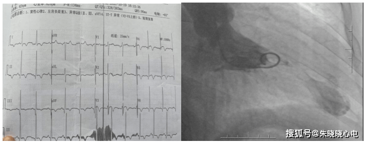 造影|3例胸痛、3份ST段抬高心电图，却是3个不同诊断！