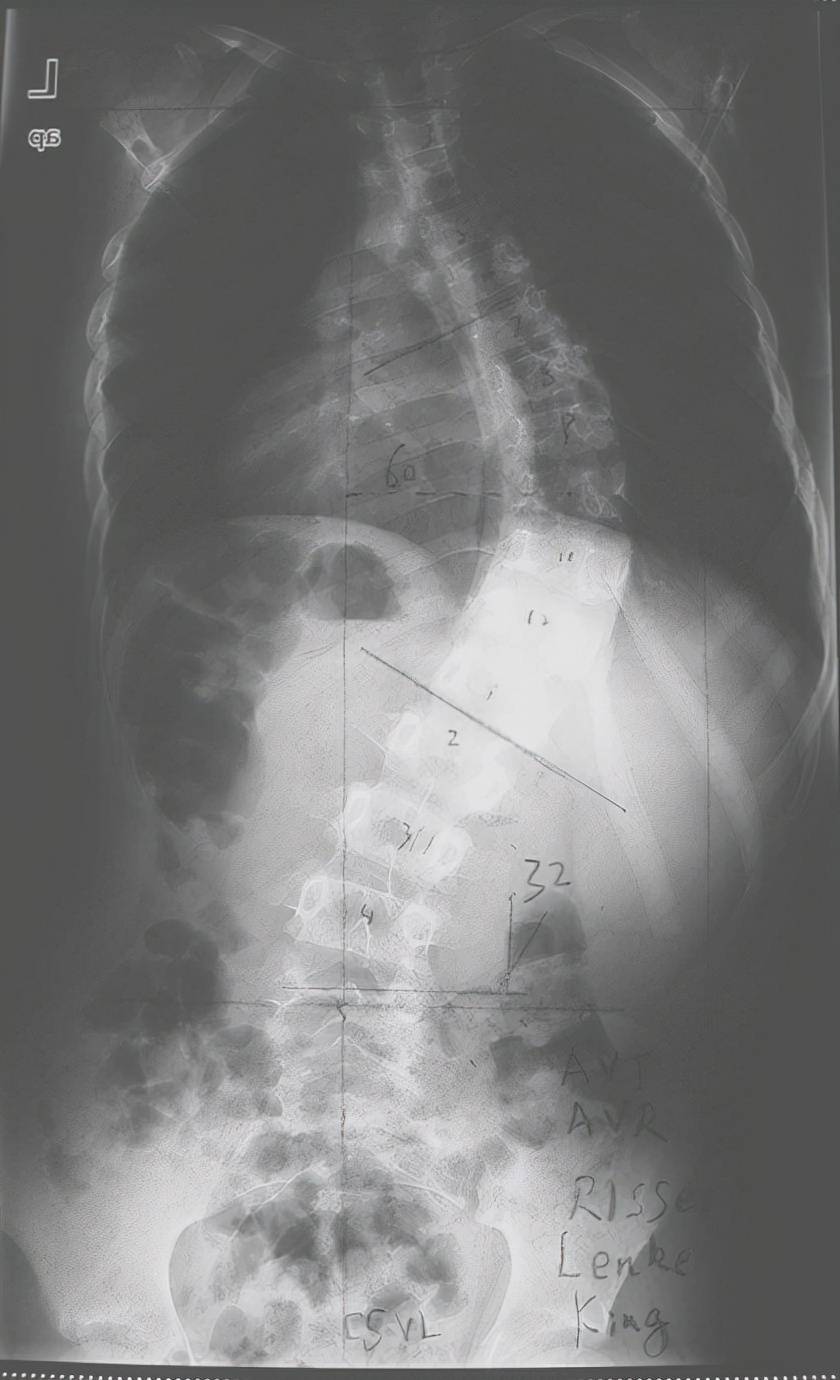 脊柱侧弯是一种复杂的三维脊柱畸形,按照年龄阶段又可以划分为:婴儿型