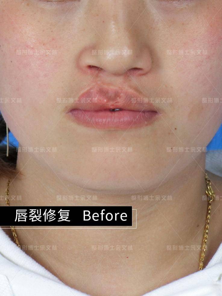 【术前诊断】双侧唇裂修复术后上唇畸形【专科检查】上唇正中部红唇