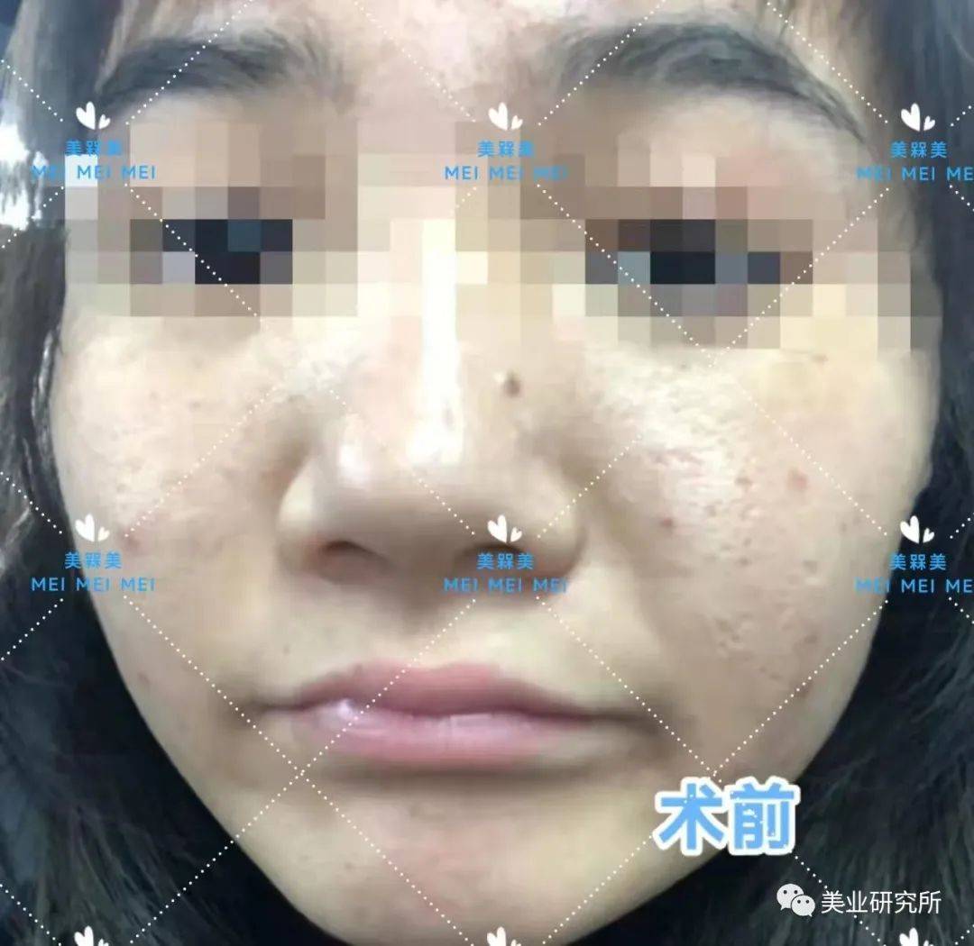 因为【美人汇】痘坑究竟该如何攻克？