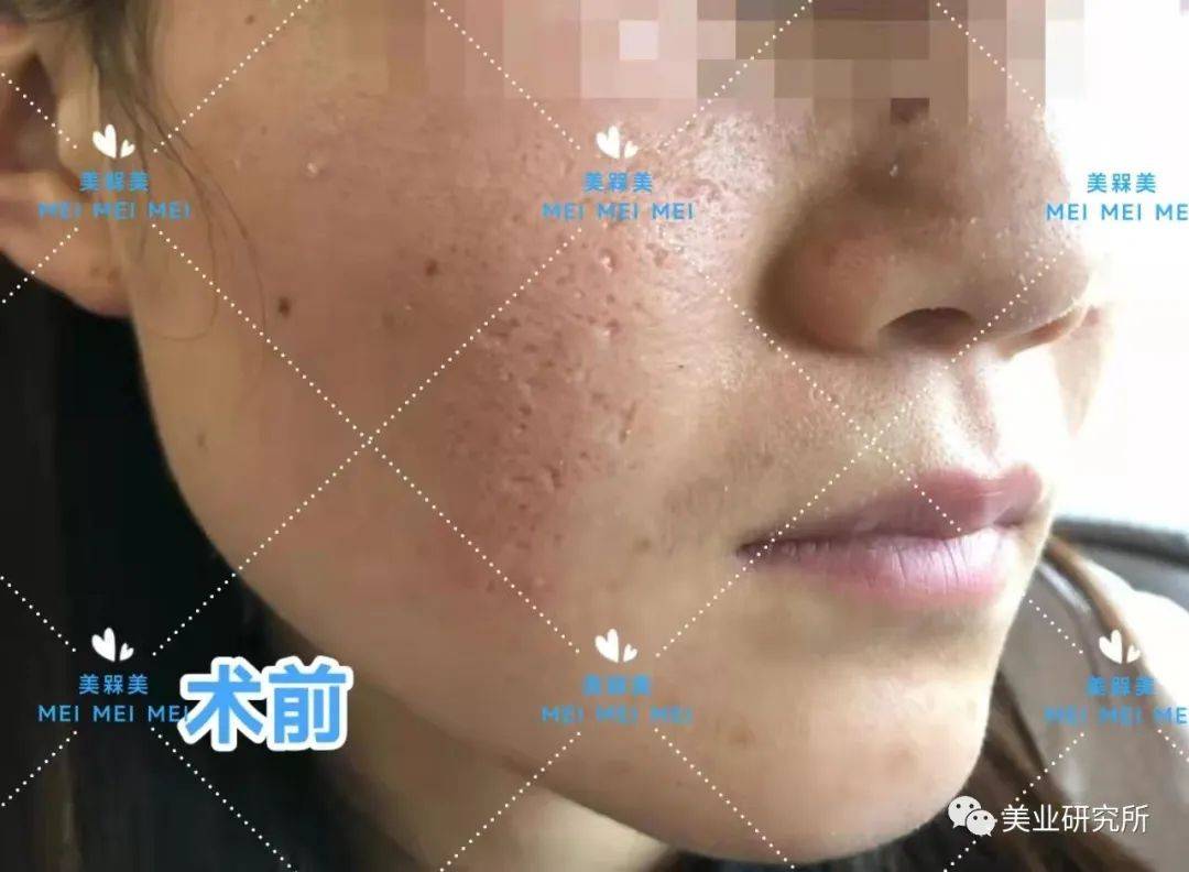 因为【美人汇】痘坑究竟该如何攻克？