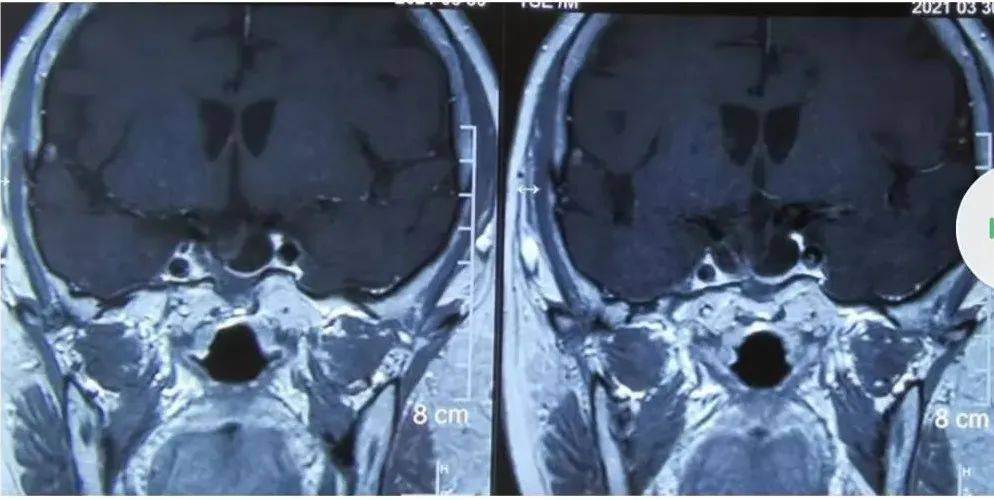 视力|识破“伪装”｜这些症状很可能和垂体腺瘤有关！