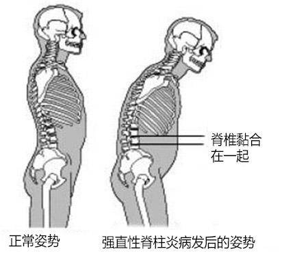 广州东方类风湿专科强直发作有哪些异常症状