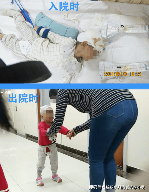 2岁儿童外伤脑出血术后脑积水伴颅内感染2月余,反复多次脑室引流并