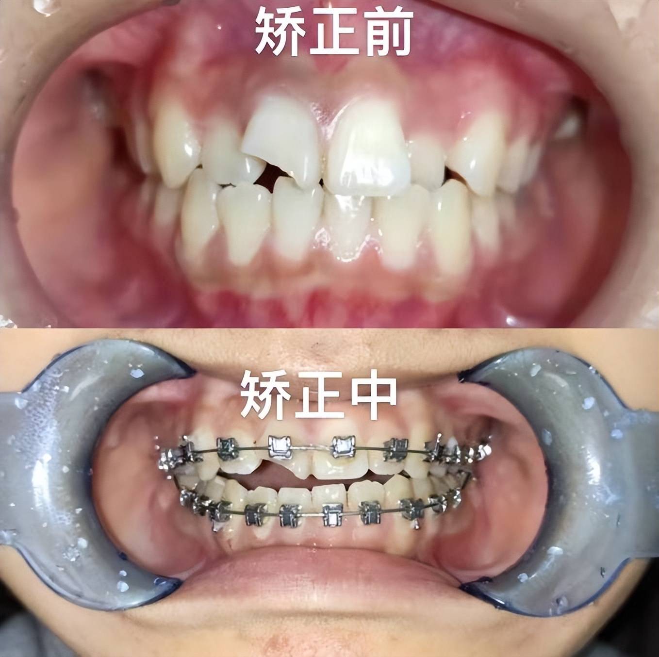 武汉13岁女孩不小心磕掉半边门牙,修复矫正后绽放自信歌喉