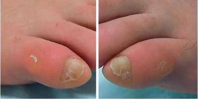 除此之外,在瑞士尼泊尔大学发表的一篇论文中,也报道了有关56位瓣状甲