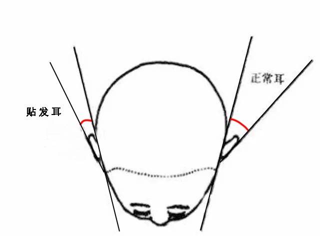 贴发耳仅仅是调整了下颅耳角就跟换了个人一样