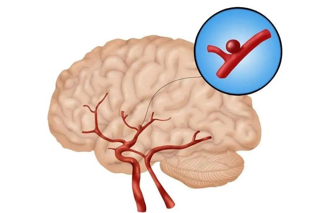 脑血管|为何脑血管疾病致死率高？这4大因素是“幕后推手”