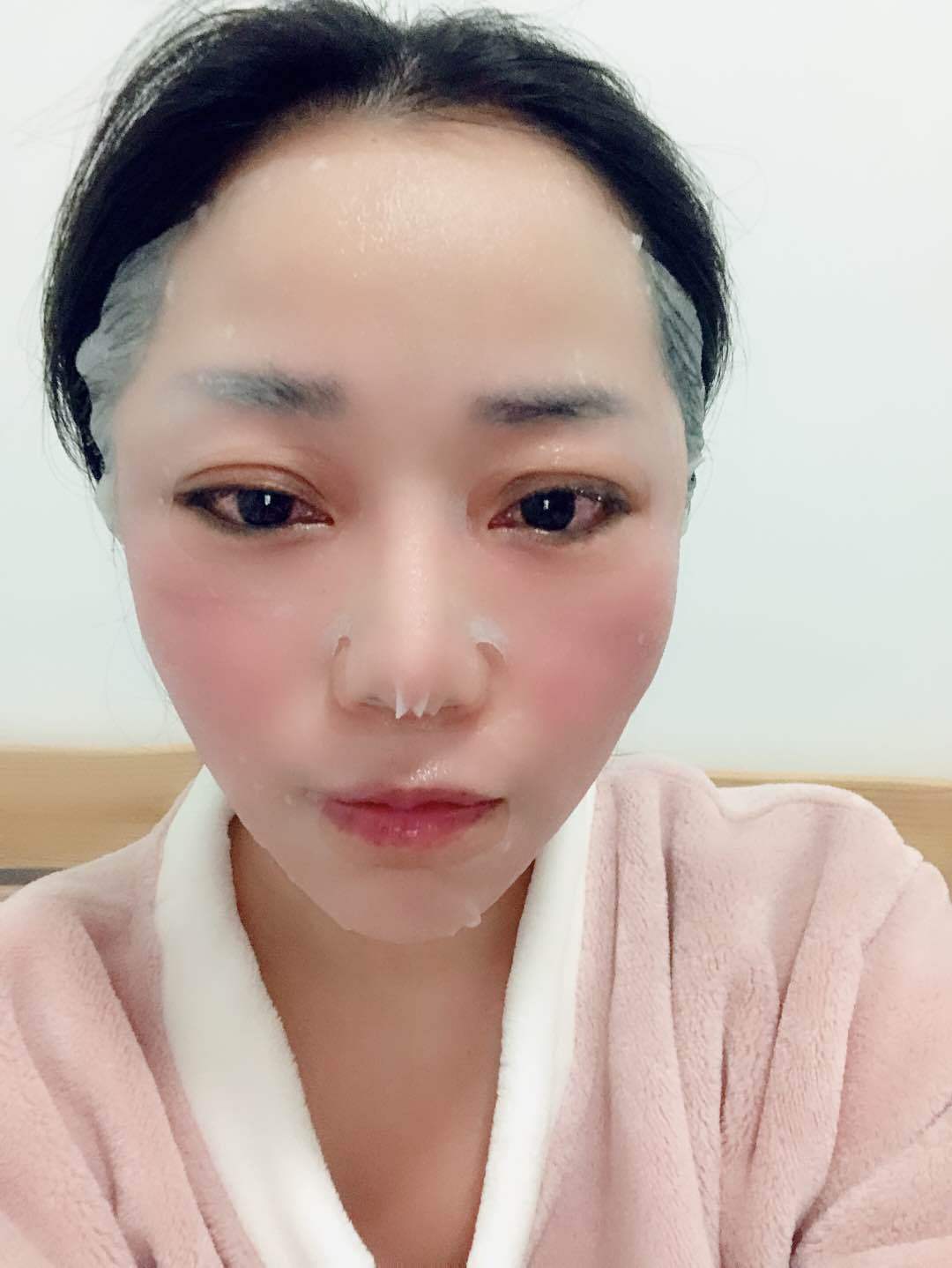 加压面部提升全过程记录，术后30天天我都经历了什么