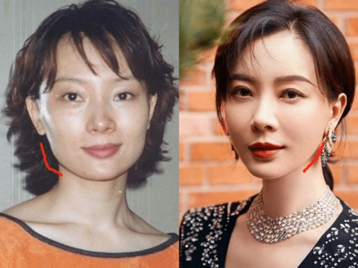 下巴整前似大妈、整完变少女？这些“回炉重造”的女明星，太成功了！
