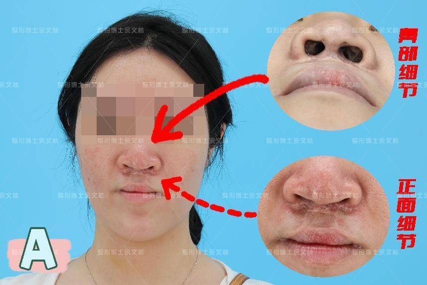 整形鼻头美容_鼻头修复整形_鼻头整形恢复期