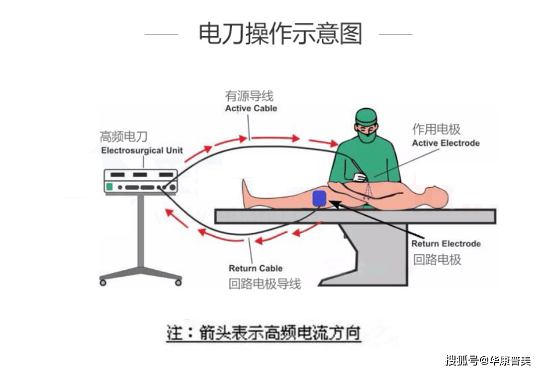 形成完整的迴路,才能完成電切或者電凝功能,單極電刀是通過負極板使