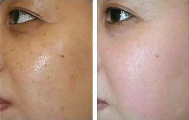 皮肤暗沉?你需要的是穴位埋线调理身体!_肤色_肌肤_智象