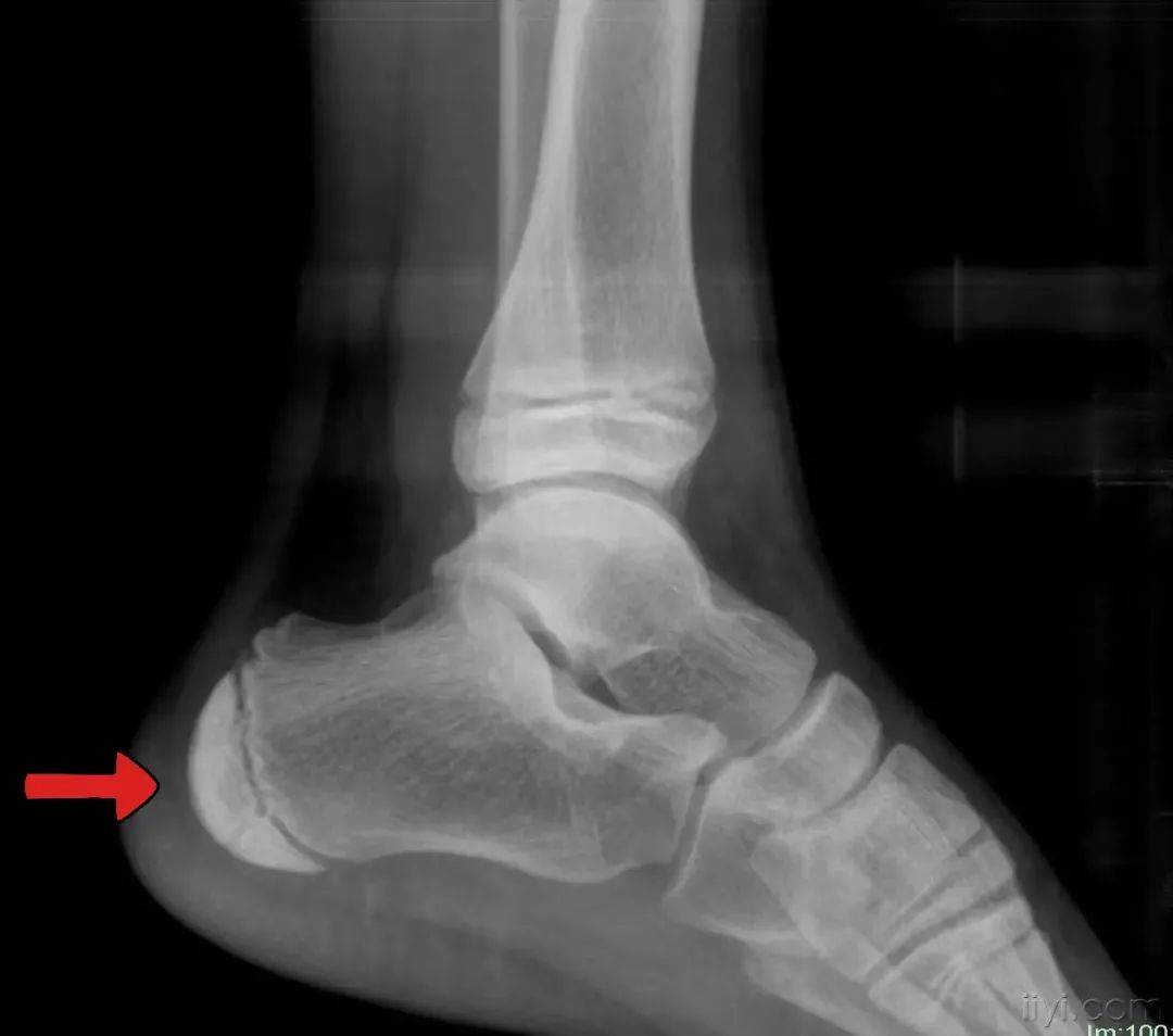 孩子脚后跟疼痛跟骨骨骺炎