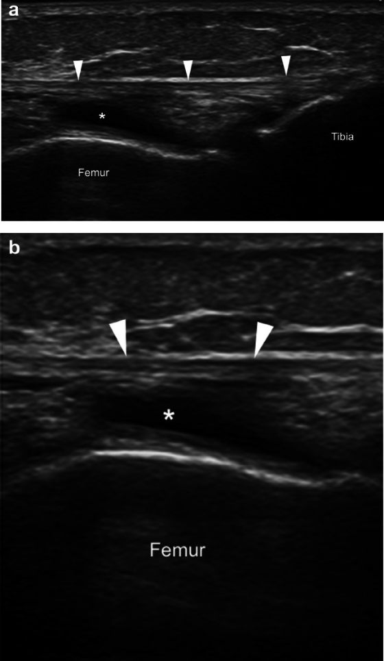 髂胫束综合症超声图像