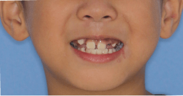 下颌后缩,牙齿拥挤不齐,牙齿错位,龅牙,牙齿间存在间隙,地包天,咬合