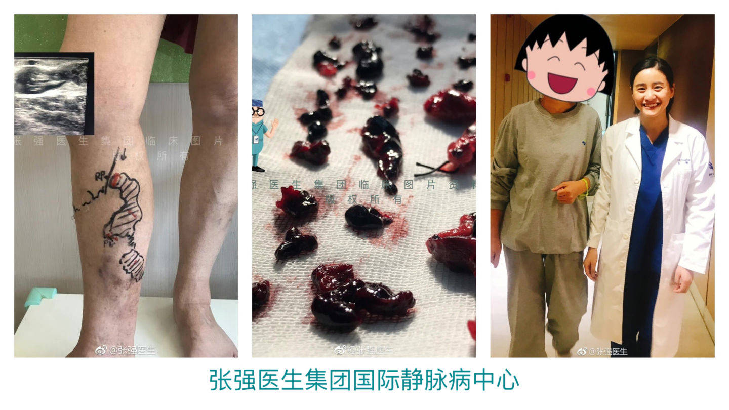 重症静脉曲张的克星,chiva治疗背后的医学逻辑_皮肤_患者_范围