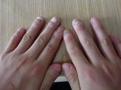 灰指甲总是反反复复一起来究其原因