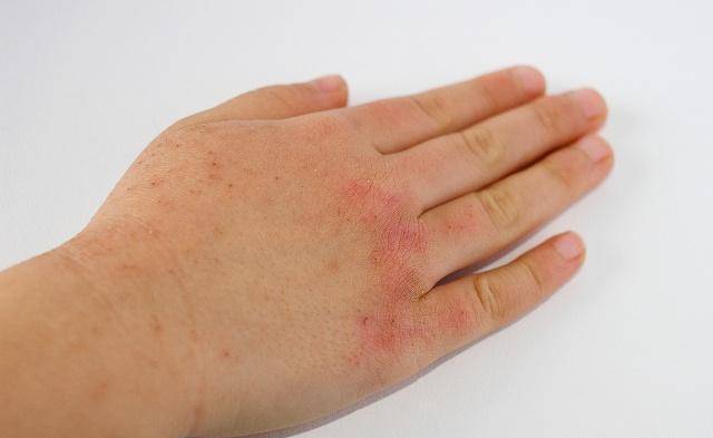 原创什么是接触性皮炎总结发现有四个常见症状