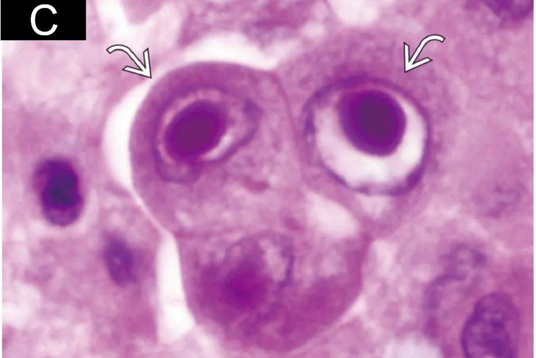 巨细胞病毒包涵体图片