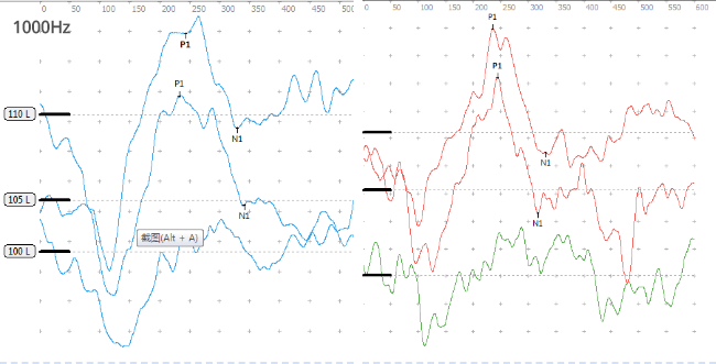 图为a型声导抗鼓室02双侧极重度感音神经性听力损失右耳平均听力>106