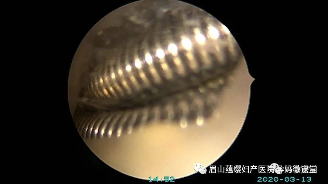 蕴缨张林主任宫腔镜下妙手取环一次解决您的多种烦恼