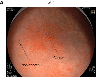 不典型增生,幽门螺旋杆菌感染等,而这些,都可以用胃镜进行诊断