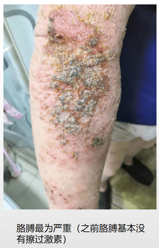 箹诗工坊:老年人四肢湿疹_腿脚_病史_过敏性