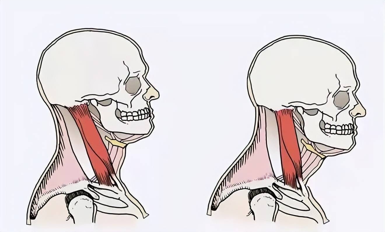 比如,低頭時間長了,胸鎖乳突肌,肩胛提肌等部位都是處於持續的緊張
