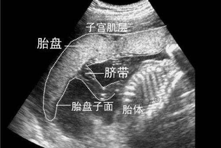 胎盘在右侧壁胎儿图片图片
