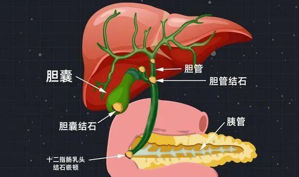 還在暴飲暴食當心胰腺炎找上門